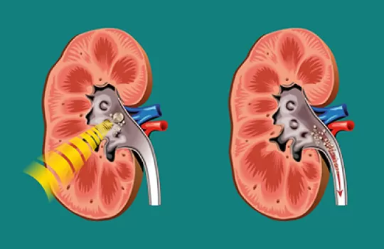 Eswl Tas Kirma Yontemi