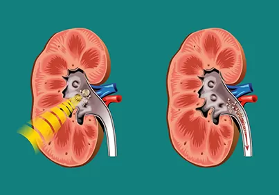 Eswl Tas Kirma Yontemi