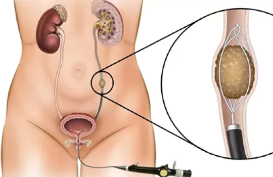 Fleksible Urs Ureter Tasi
