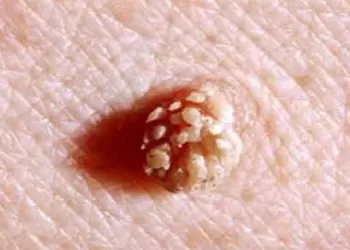 Genital Siğil Tedavisi