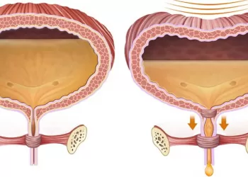 İnterstisyel Sistit Hidrodistansiyon Tedavisi