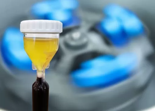 PRP Tedavisi - Erkek ve Kadınların Ürolojik Hastalıklarında