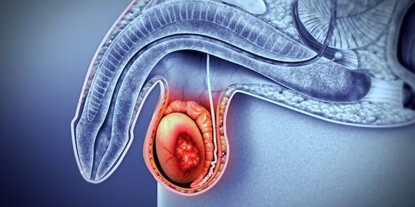 Spermatosel Skleroterapi