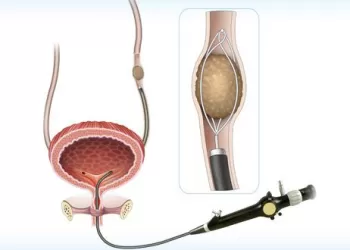 Üreteroskopi, Bükülebilir Fleksibıl Üreteroskopi