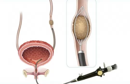 Üreteroskopi, Bükülebilir Fleksibıl Üreteroskopi