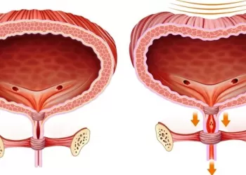 Ürodinami Testinin Kullanıldığı Durumlar