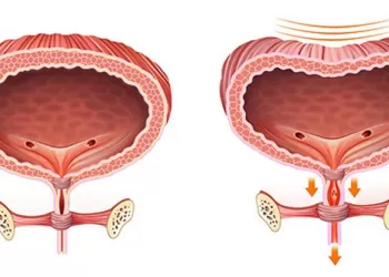 Aşırı Aktif Mesane Nedir? Aktif Mesane Nedenleri ve Belirtileri