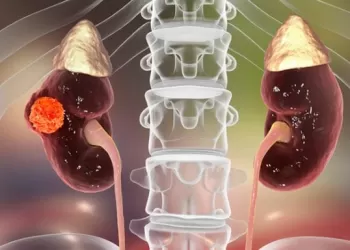 Böbrek Kanseri Kimlerde Görülür?