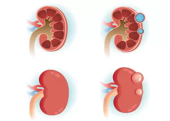 Böbrek Kisti Nedir? Böbrekte Kist Belirtileri Nelerdir?