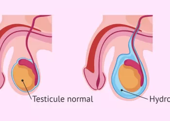 Hidrosel Nedir? Nedenleri Nelerdir?