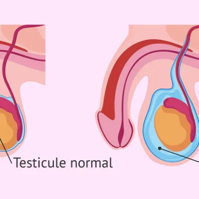 Hidrosel Nedir? Nedenleri Nelerdir?
