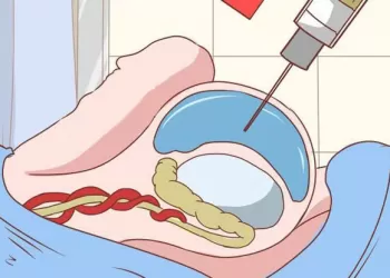 Hidrosel İğne Aspirasyonu-Ameliyatsız Hidrosel Tedavisi-Skleroterapi