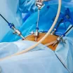 Laparoskopik Cerrahi Nasıl Yapılır?