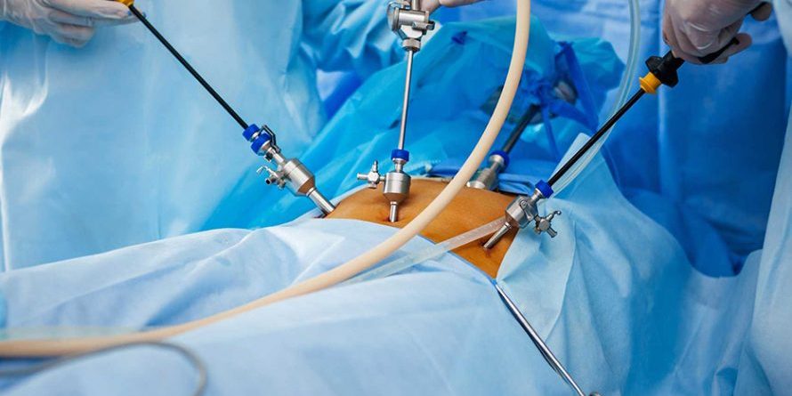 Laparoskopik Cerrahi Nasıl Yapılır?