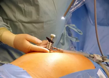 Laparoskopik Cerrahi Nedir?