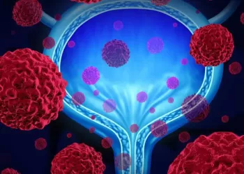 Mesane Kanseri Evreleri