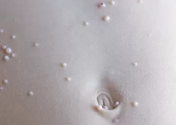 Molluskum Kontagiosum Tedavisi