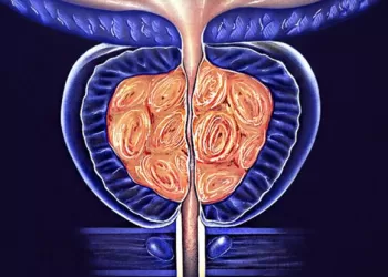 Penis Kanseri İçin Kemoterapi Tedavisi
