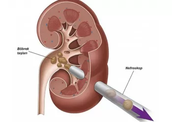 Perkütan Taş Cerrahisi Nedir Nasıl Uygulanır?