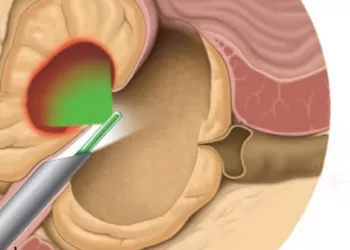 Plazma Kinetik Prostat Ameliyatı Nasıl Uygulanır?