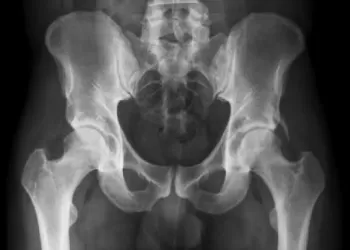 Posterior Üretral Valv Nedenleri