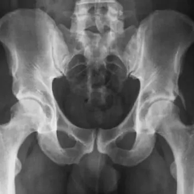 Posterior Üretral Valv Nedenleri