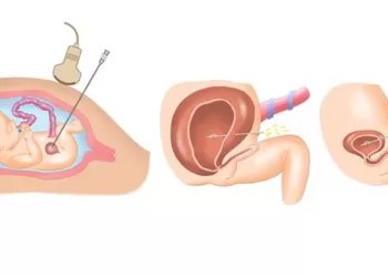 Posterior Üretral Valv Tedavisinde Üreterostomi Nefrostomi