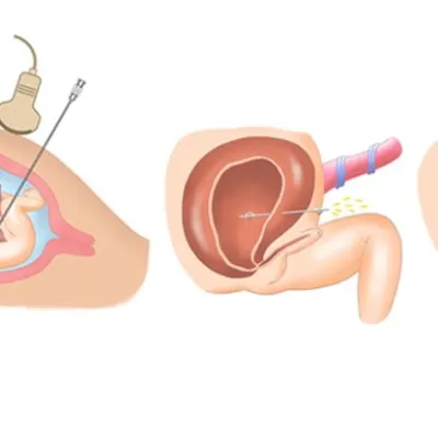 Posterior Üretral Valv Tedavisinde Üreterostomi Nefrostomi