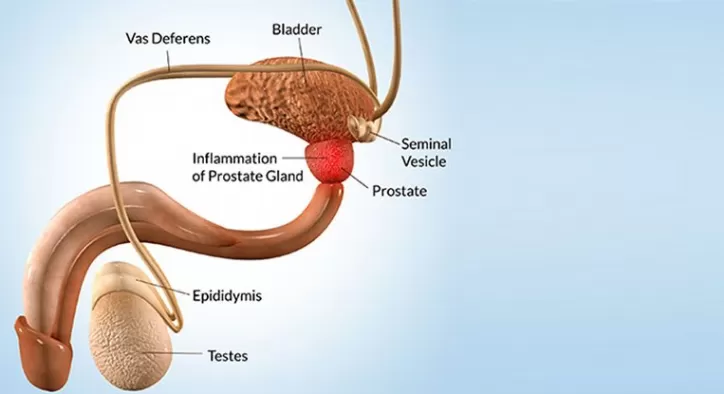 Prostatit Nedir? Neden Oluşur?