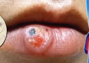 Şankroid Tedavisi – Kullanılan Yöntemler ve İlaçlar