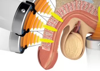 Sertleşme Sorununda Şok Dalga Tedavisi