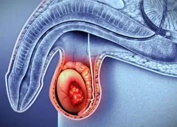 Spermatosel Sorununa Skleroterapi