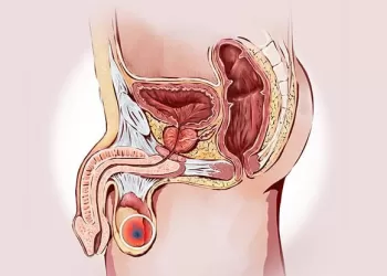 Testis Kanseri Tedavisi