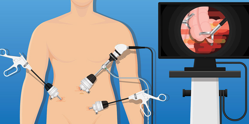 UPJ Darlığında Laparoskopik Pyeloplasti