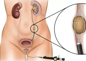 Üreter Taşı Tedavisi Üreteroskopi (URS)