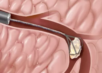 Ürolojide Endoskopik Cerrahi