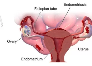Vezikovajinal Fistül Tedavisinde Konservatif Yaklaşım