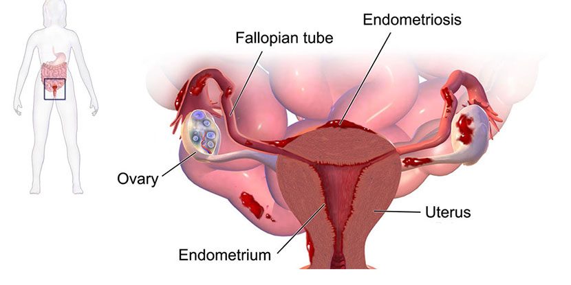 Vezikovajinal Fistül Tedavisinde Konservatif Yaklaşım