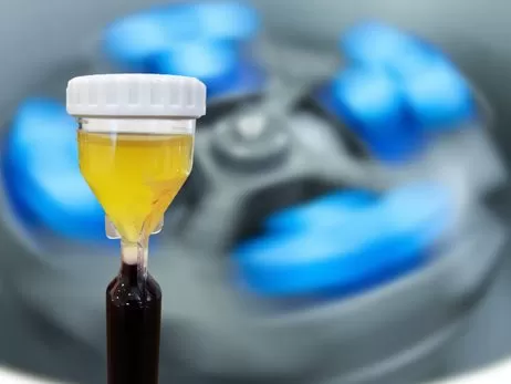 PRP (platelet rich plasma) ozonated PRP
