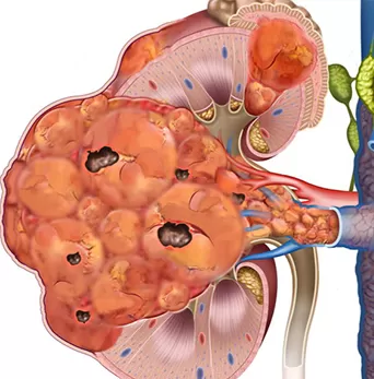 Renal Cancer Tumor Thrombosis 1