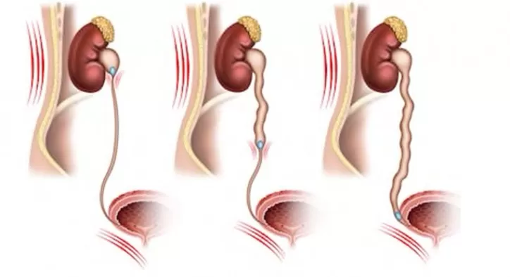 Ureter Tasi