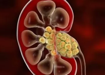 Böbrek Taşı Tedavisinde RIRS Yöntemi Kimler İçin Uygun?