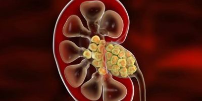 Böbrek Taşı Tedavisinde RIRS Yöntemi Kimler İçin Uygun?