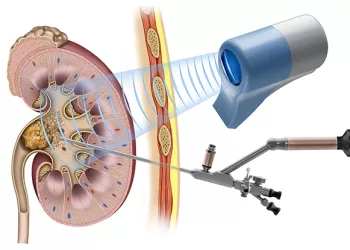 Böbrek Taşı Tedavisinde Perkütan Nefrolitotomi (PNL, PCNL) Yöntemi