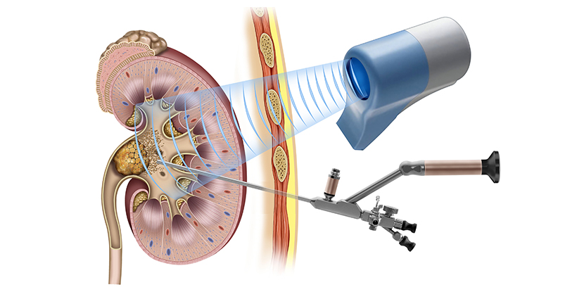 Böbrek Taşı Tedavisinde Perkütan Nefrolitotomi (PNL, PCNL) Yöntemi