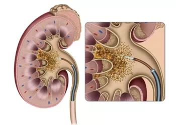 Böbrek Taşı Tedavisinde Fleksible URS Yöntemi (RIRS Yöntemi)