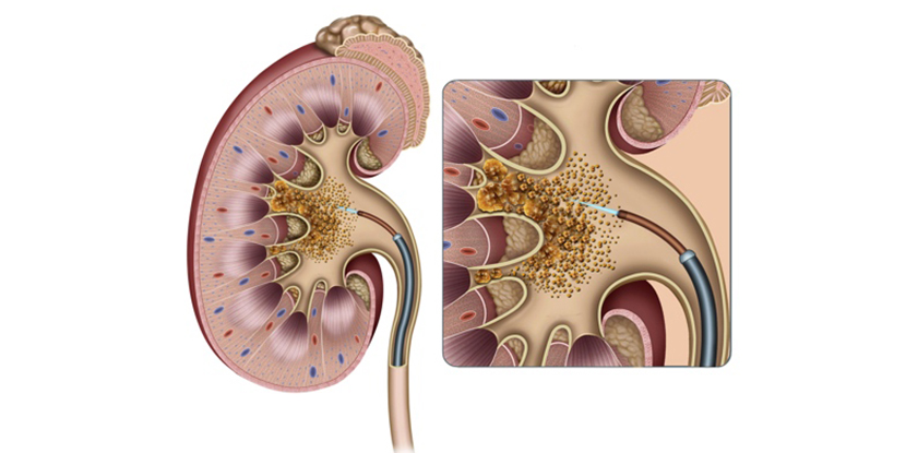 Böbrek Taşı Tedavisinde Fleksible URS Yöntemi (RIRS Yöntemi)