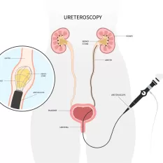Flexible Üreteroskopi Nasıl Uygulanır?
