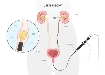 Flexible Üreteroskopi Nasıl Uygulanır?