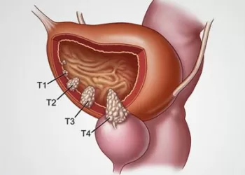Mesane Kanserinde TUR Yöntemi